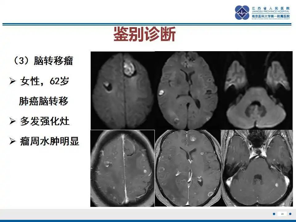 影像PPT - 【PPT】特鲁索综合征 Trousseau snydrome-29