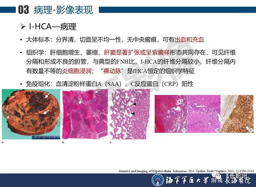 影像PPT - 【PPT】肝细胞腺瘤的影像学诊断-11