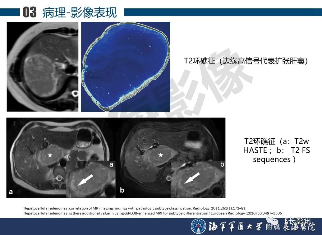 影像PPT - 【PPT】肝细胞腺瘤的影像学诊断-13