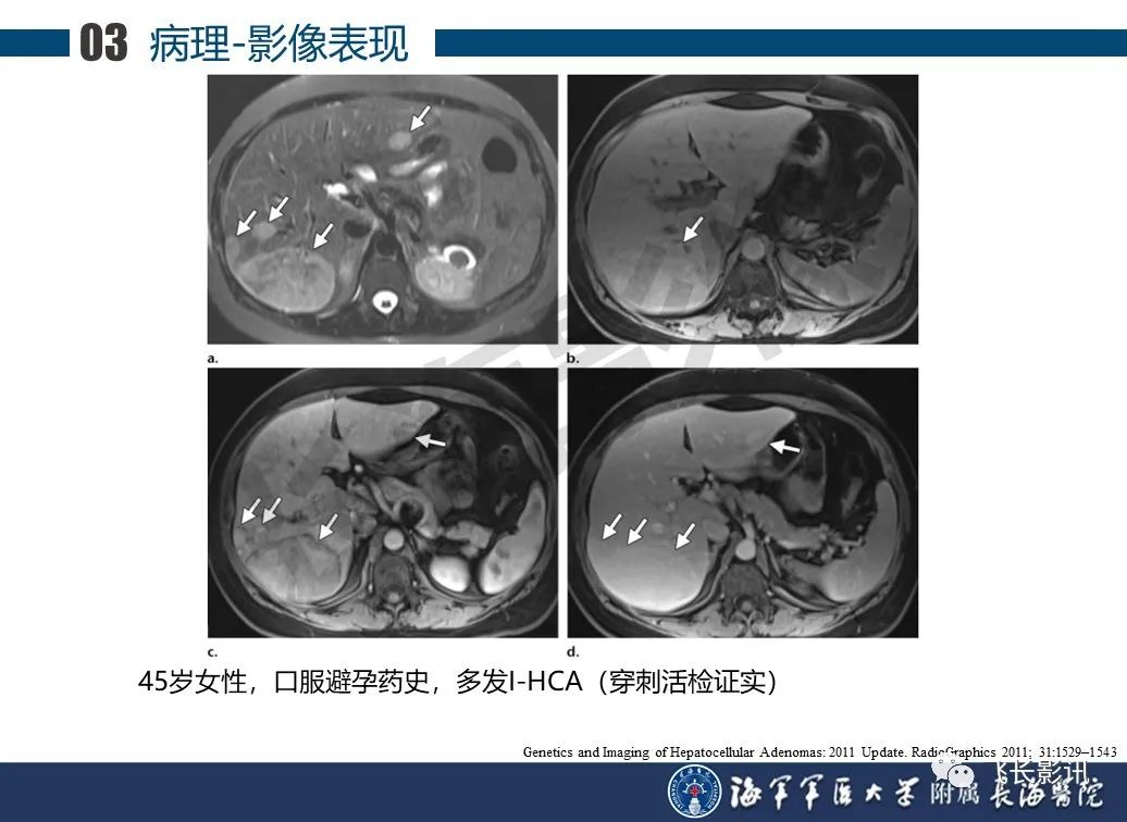 影像PPT - 【PPT】肝细胞腺瘤的影像学诊断-14