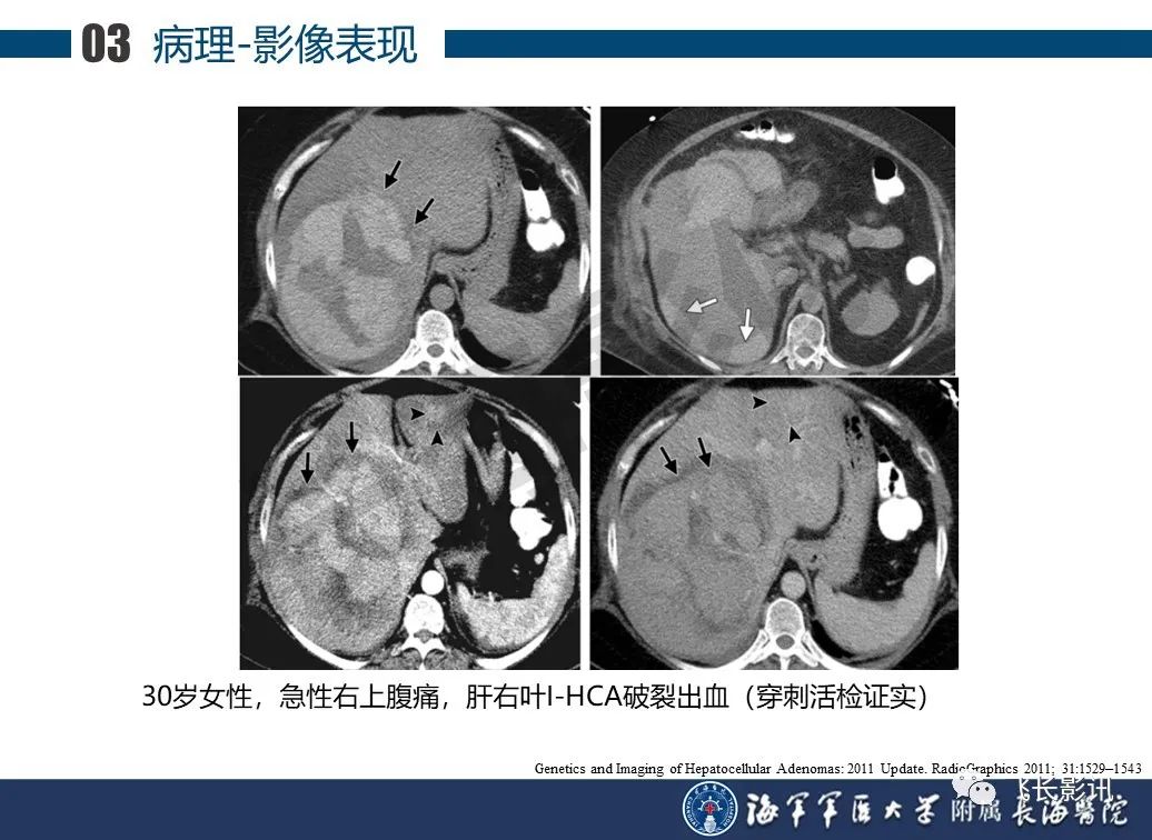 影像PPT - 【PPT】肝细胞腺瘤的影像学诊断-15