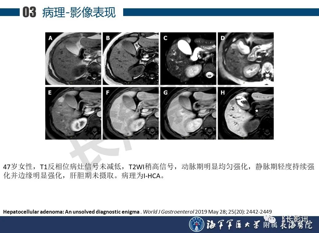 影像PPT - 【PPT】肝细胞腺瘤的影像学诊断-16