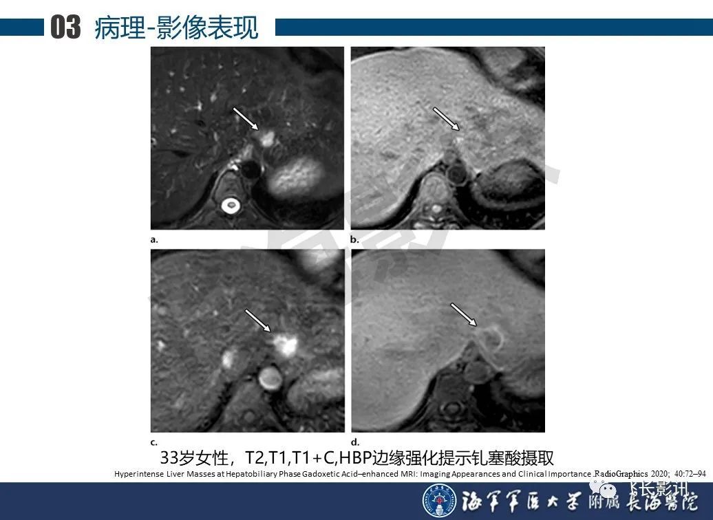 影像PPT - 【PPT】肝细胞腺瘤的影像学诊断-17