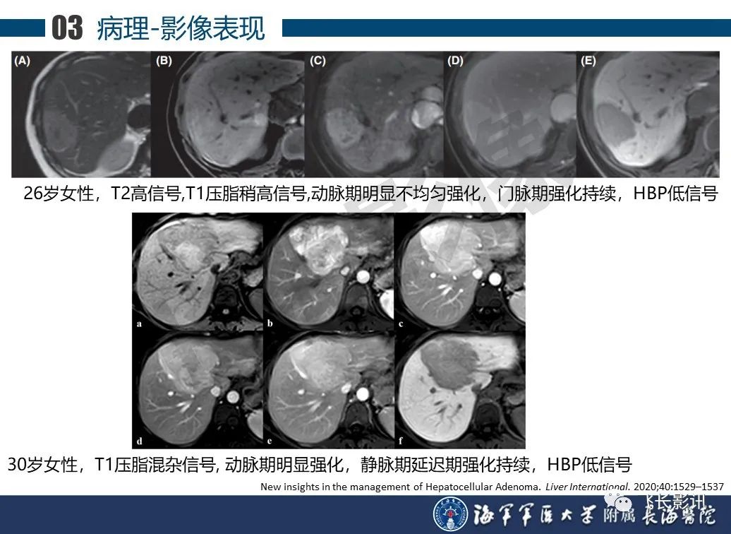 影像PPT - 【PPT】肝细胞腺瘤的影像学诊断-18