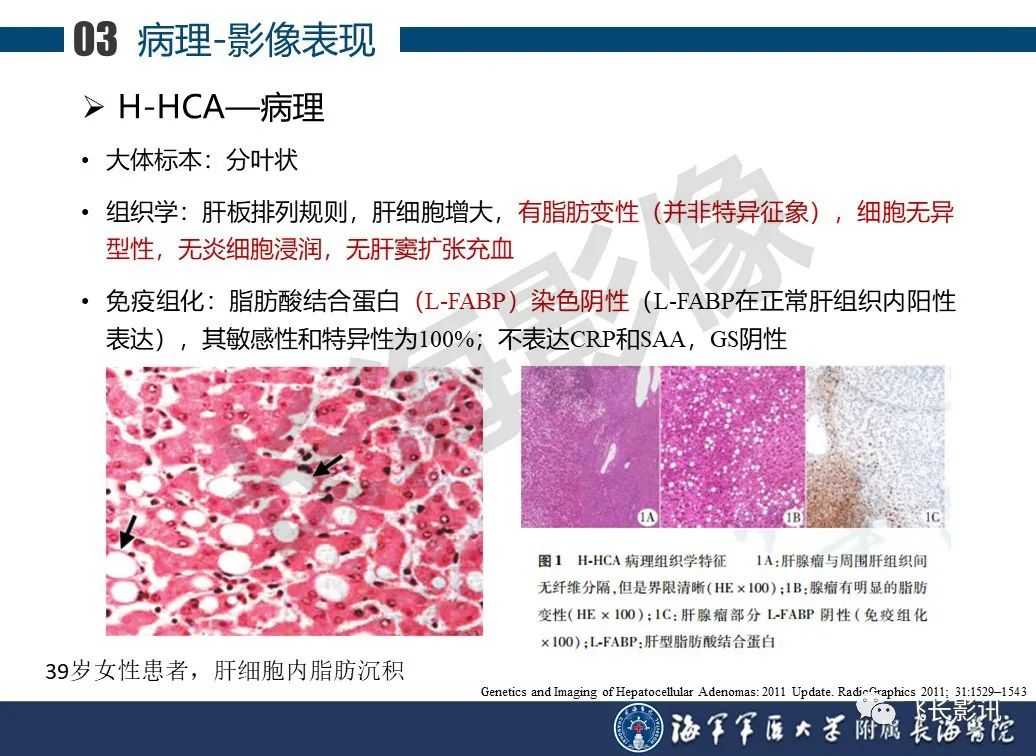 影像PPT - 【PPT】肝细胞腺瘤的影像学诊断-21