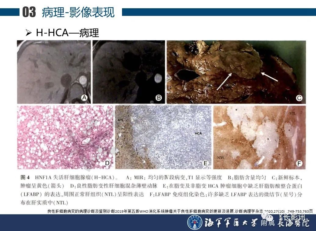 影像PPT - 【PPT】肝细胞腺瘤的影像学诊断-22