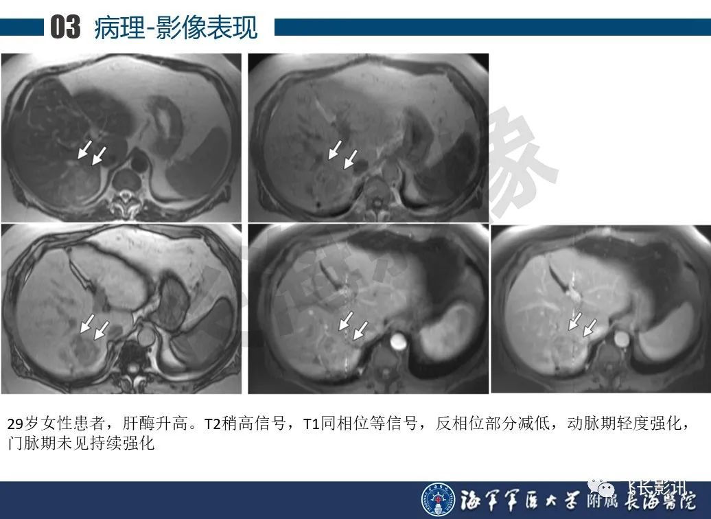 影像PPT - 【PPT】肝细胞腺瘤的影像学诊断-24