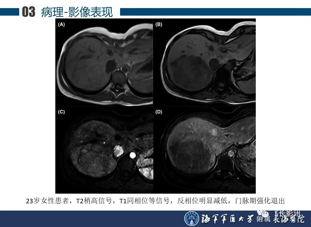 影像PPT - 【PPT】肝细胞腺瘤的影像学诊断-25