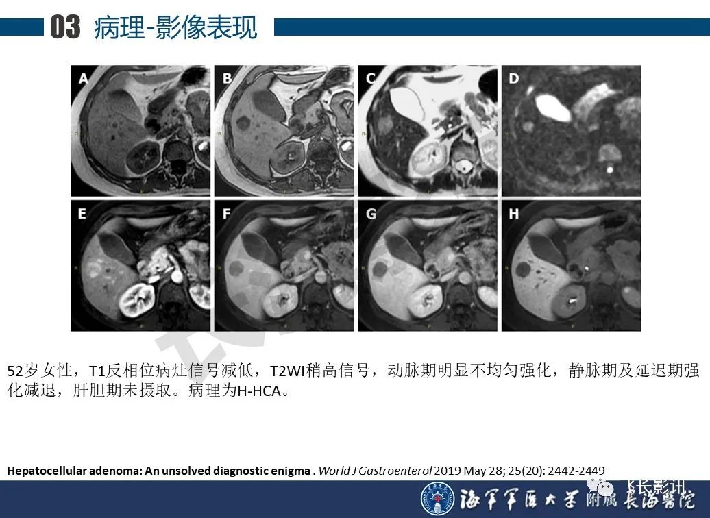 影像PPT - 【PPT】肝细胞腺瘤的影像学诊断-26