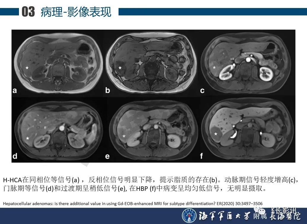 影像PPT - 【PPT】肝细胞腺瘤的影像学诊断-27
