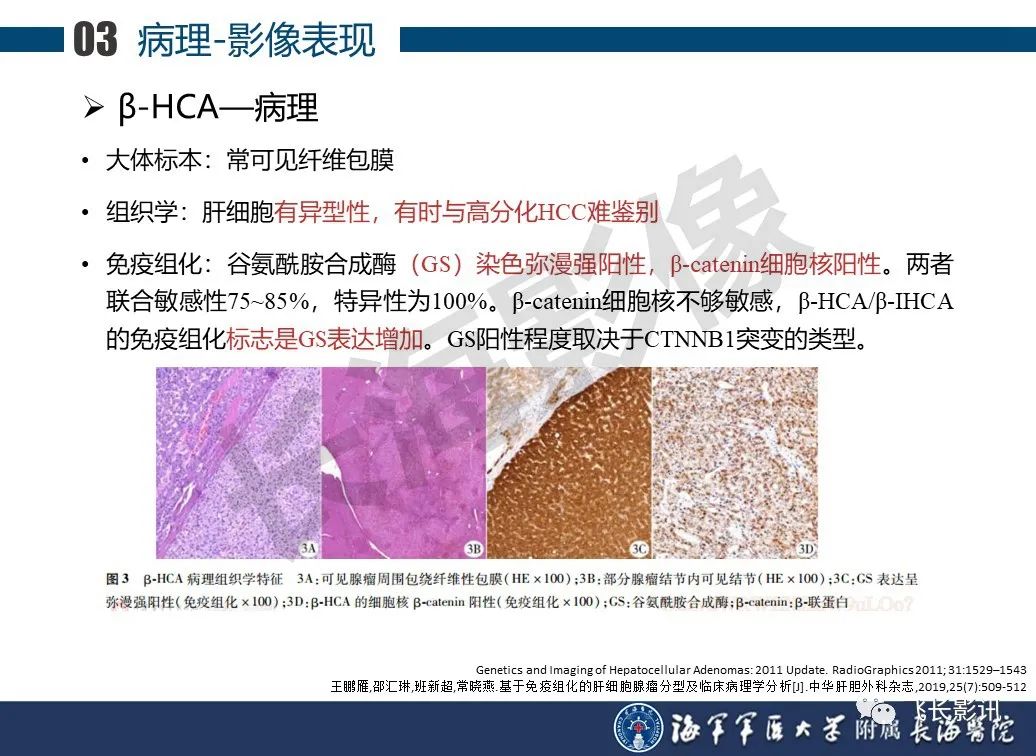 影像PPT - 【PPT】肝细胞腺瘤的影像学诊断-30