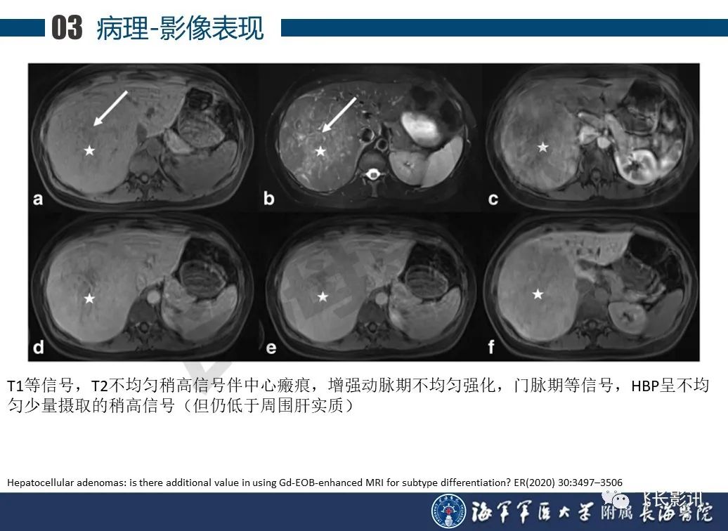 影像PPT - 【PPT】肝细胞腺瘤的影像学诊断-33