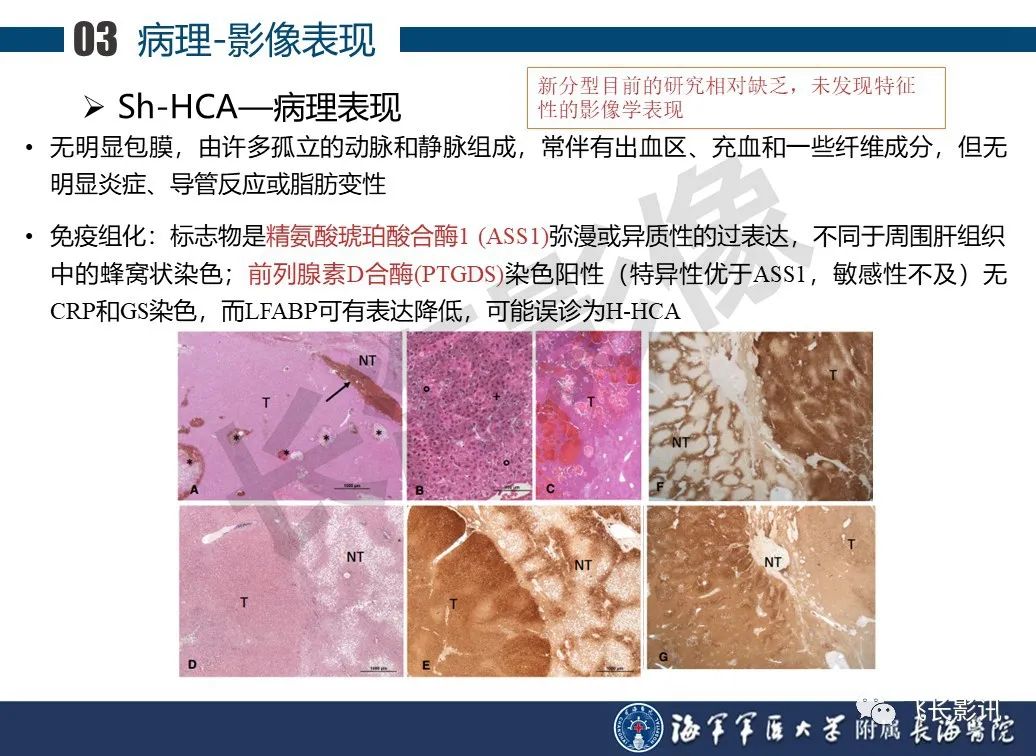 影像PPT - 【PPT】肝细胞腺瘤的影像学诊断-35