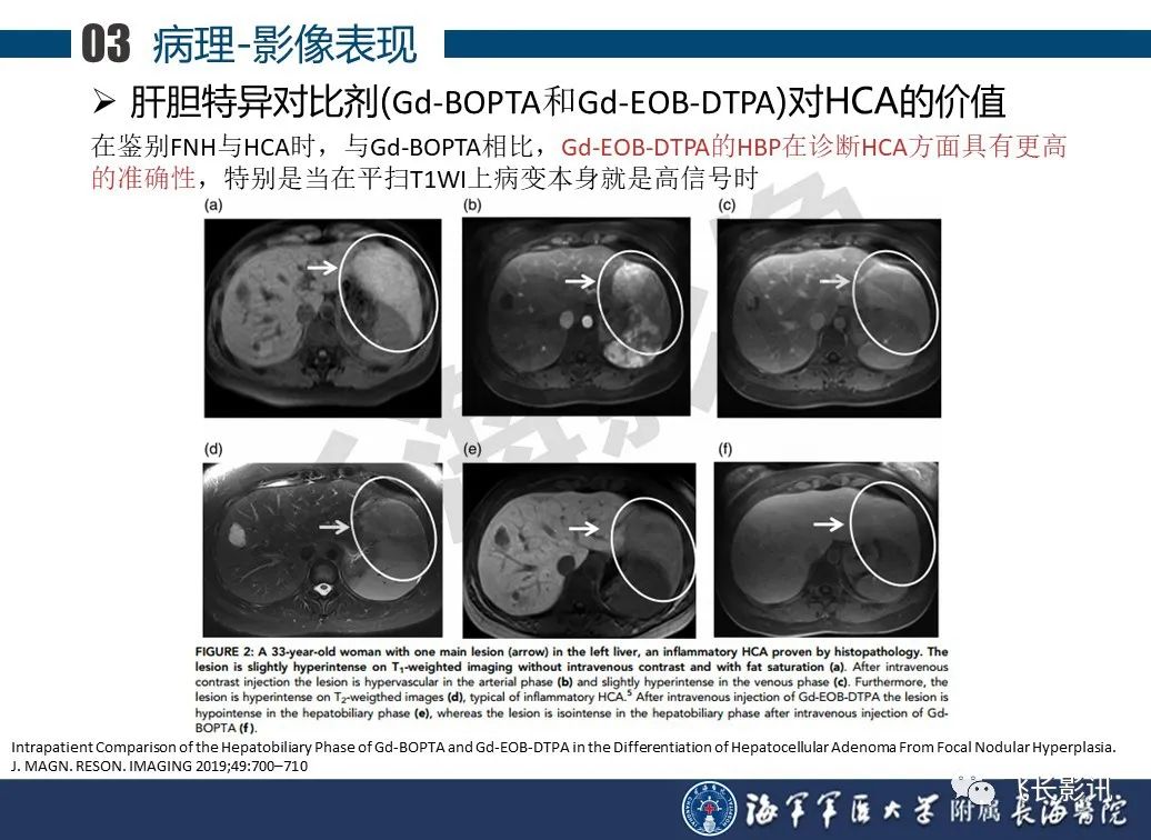 影像PPT - 【PPT】肝细胞腺瘤的影像学诊断-38