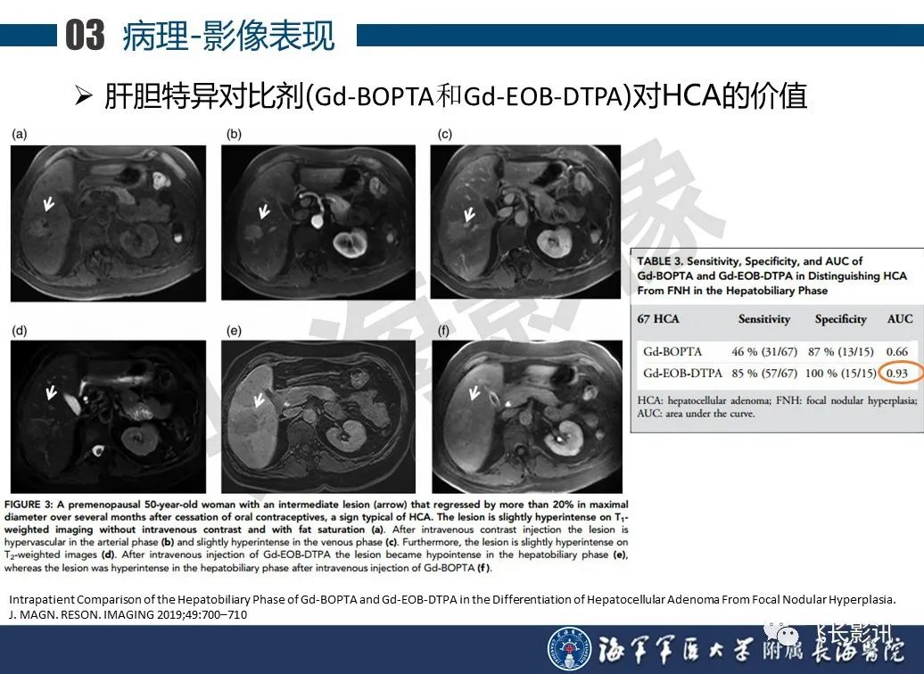 影像PPT - 【PPT】肝细胞腺瘤的影像学诊断-39