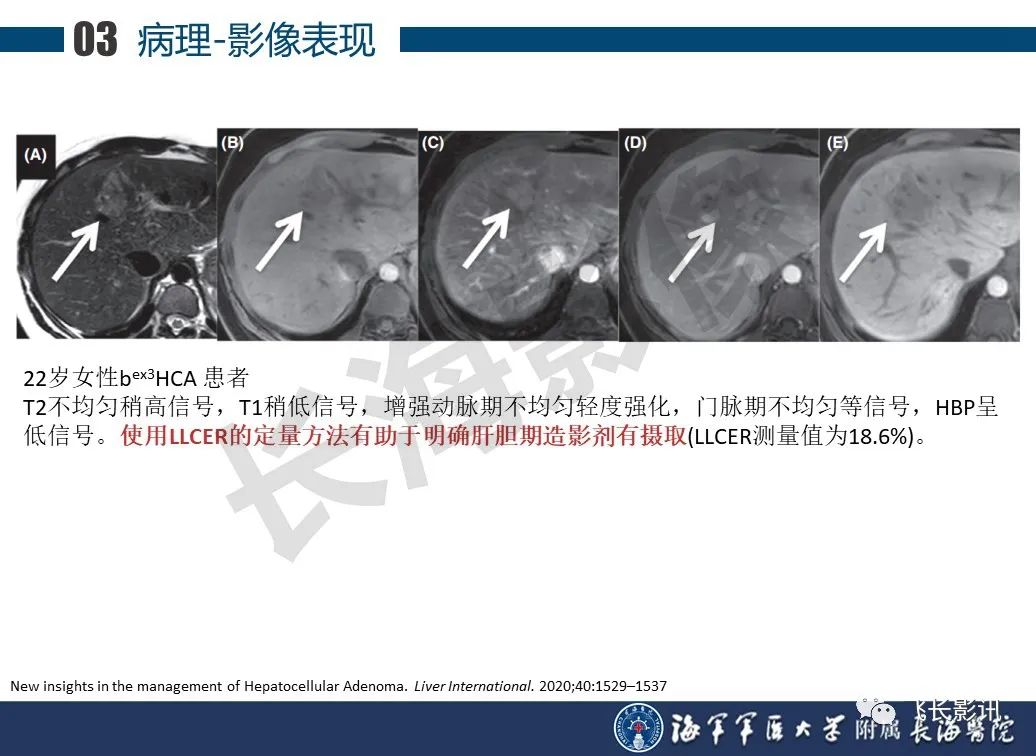 影像PPT - 【PPT】肝细胞腺瘤的影像学诊断-43