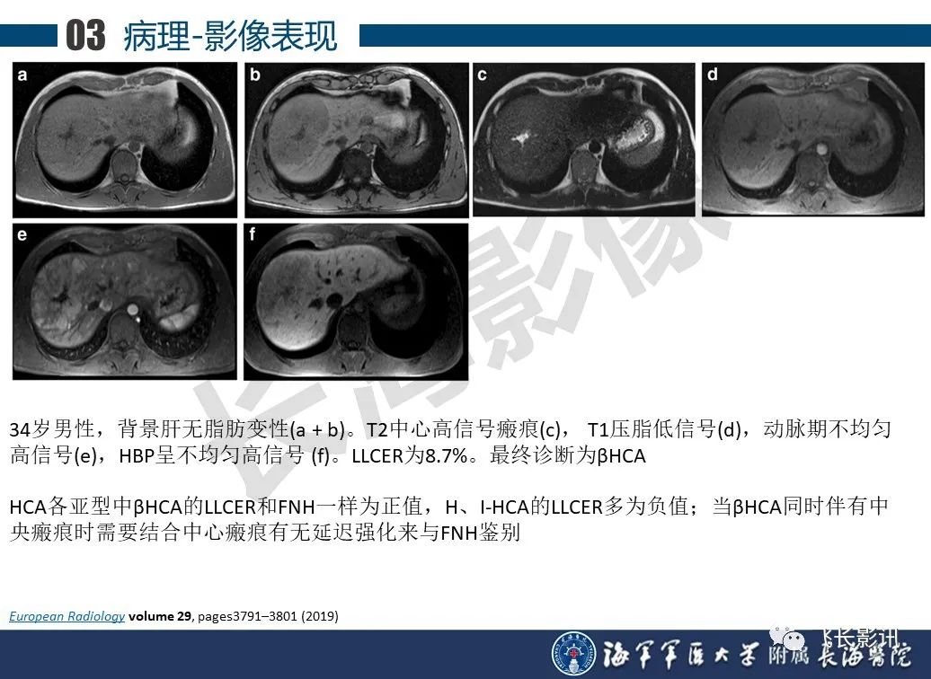 影像PPT - 【PPT】肝细胞腺瘤的影像学诊断-44