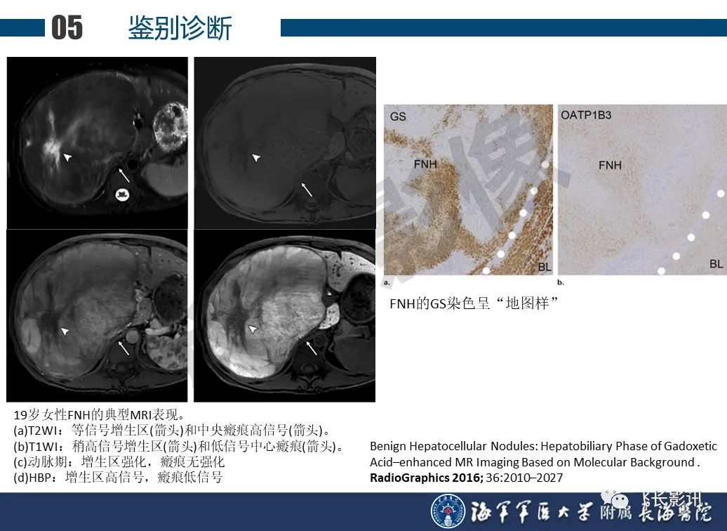 影像PPT - 【PPT】肝细胞腺瘤的影像学诊断-52