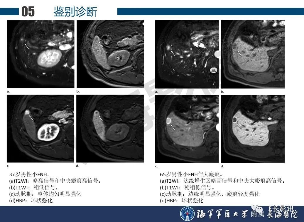 影像PPT - 【PPT】肝细胞腺瘤的影像学诊断-53