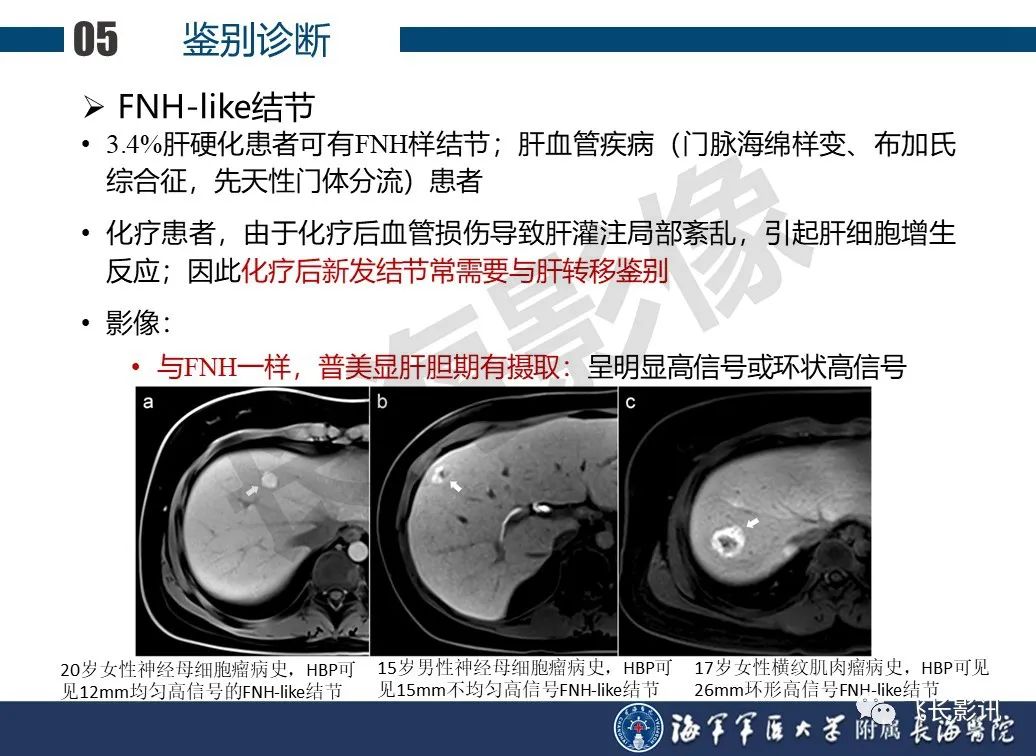 影像PPT - 【PPT】肝细胞腺瘤的影像学诊断-54