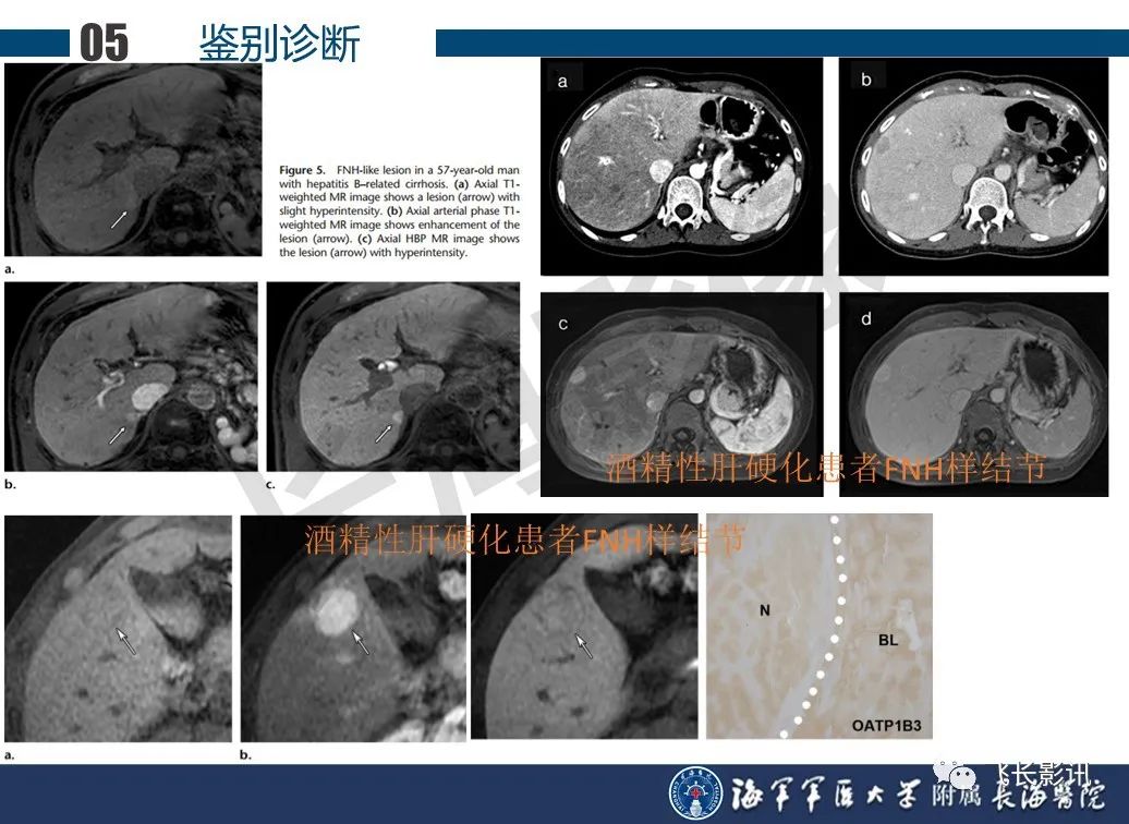影像PPT - 【PPT】肝细胞腺瘤的影像学诊断-55