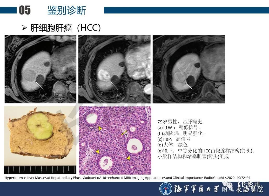 影像PPT - 【PPT】肝细胞腺瘤的影像学诊断-57