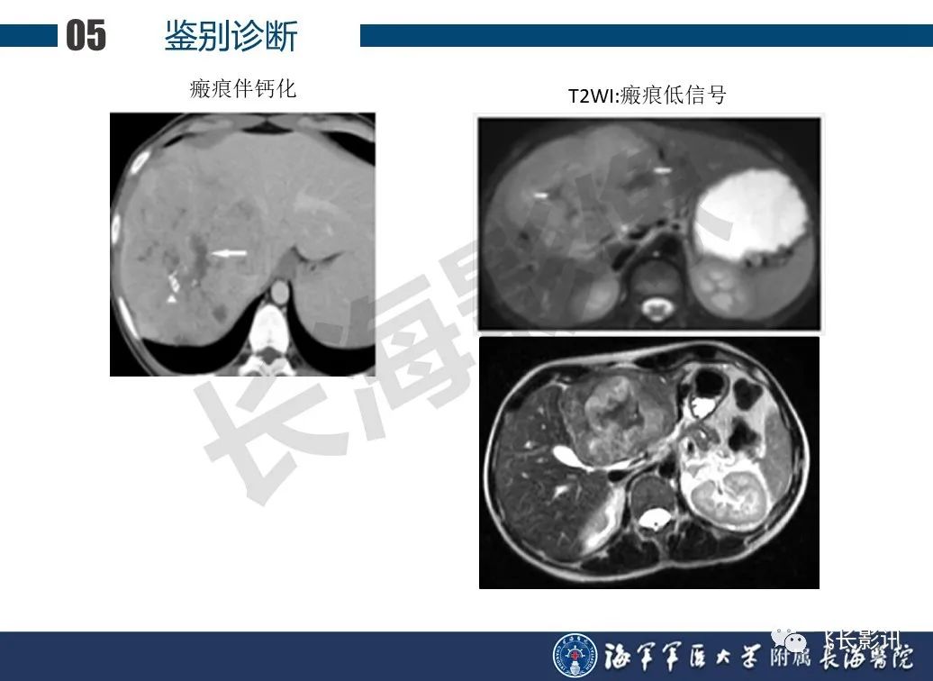 影像PPT - 【PPT】肝细胞腺瘤的影像学诊断-59
