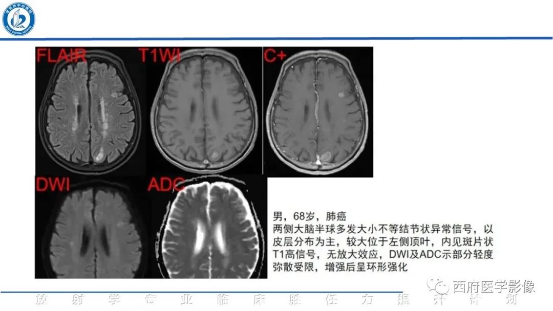 影像PPT - 【PPT】特鲁索综合征影像诊断与鉴别-21