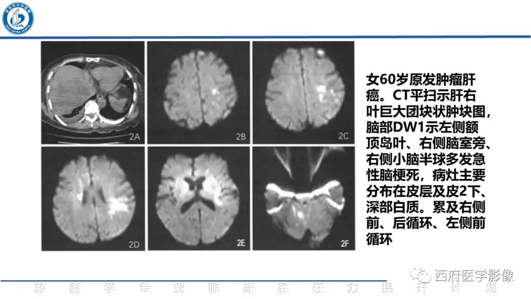 影像PPT - 【PPT】特鲁索综合征影像诊断与鉴别-23