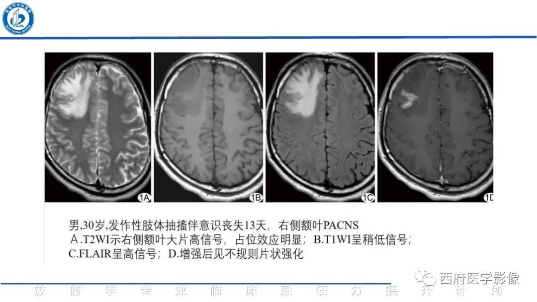影像PPT - 【PPT】特鲁索综合征影像诊断与鉴别-29