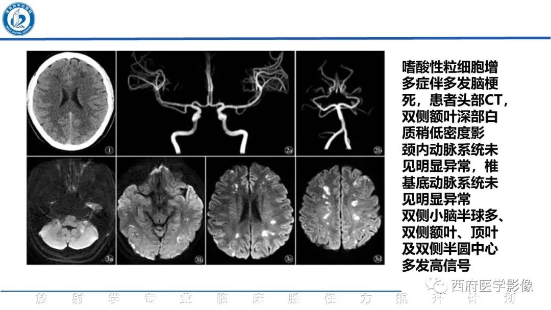 影像PPT - 【PPT】特鲁索综合征影像诊断与鉴别-4