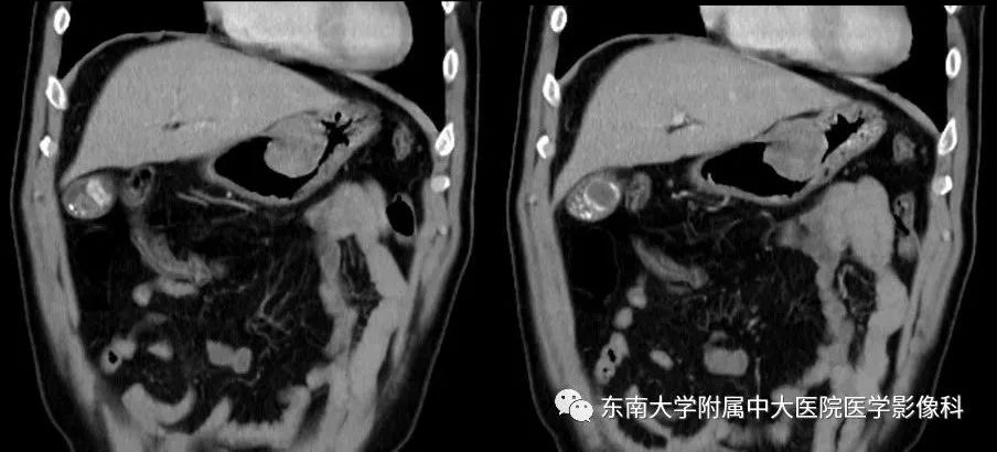 影像PPT - 【PPT】胃肠道间质瘤GIST-2