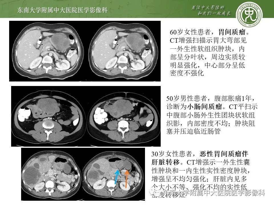 影像PPT - 【PPT】胃肠道间质瘤GIST-10