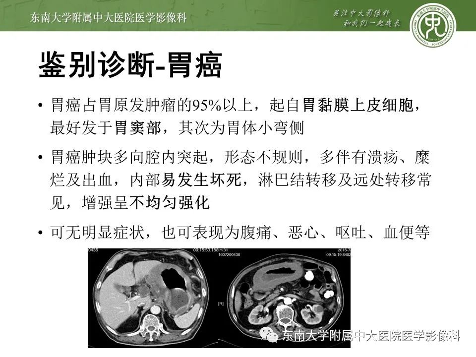 影像PPT - 【PPT】胃肠道间质瘤GIST-11