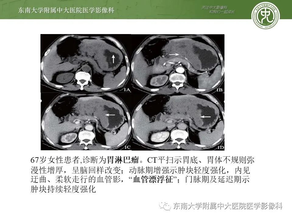 影像PPT - 【PPT】胃肠道间质瘤GIST-13