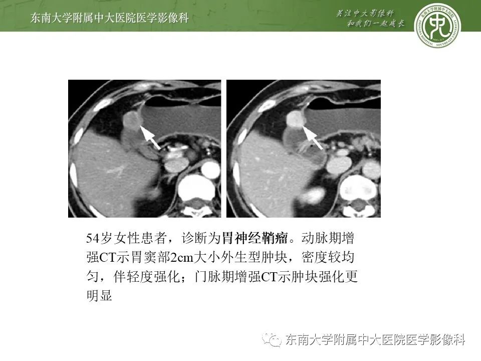 影像PPT - 【PPT】胃肠道间质瘤GIST-15