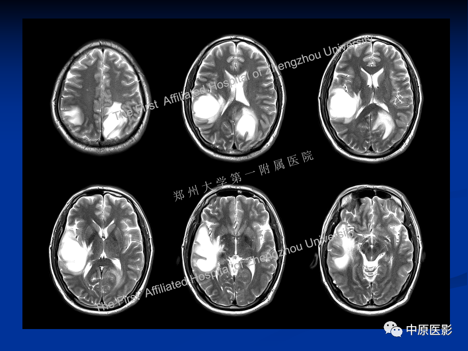 影像PPT - 【病例】脱髓鞘假瘤1例MR影像-5