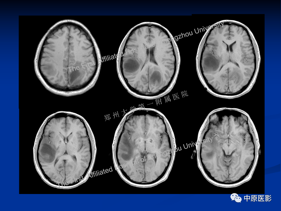 影像PPT - 【病例】脱髓鞘假瘤1例MR影像-4
