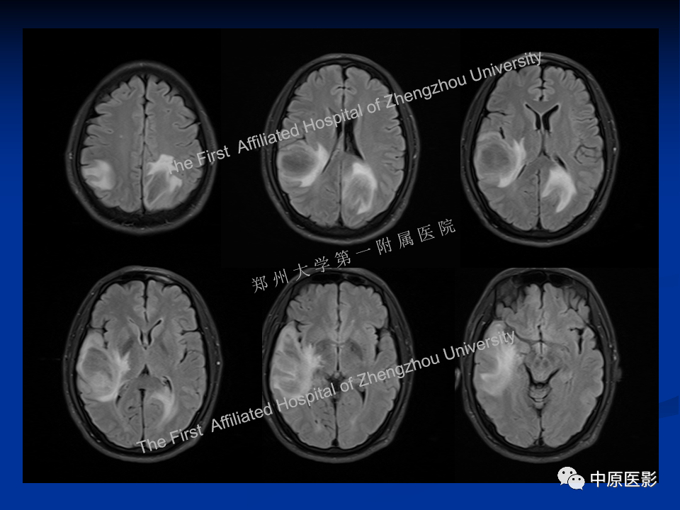 影像PPT - 【病例】脱髓鞘假瘤1例MR影像-6