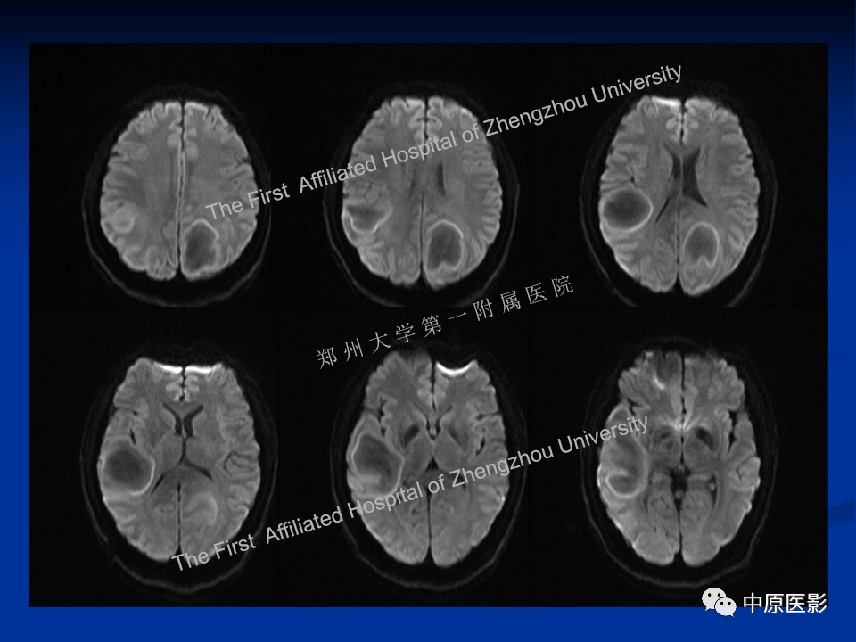 影像PPT - 【病例】脱髓鞘假瘤1例MR影像-7