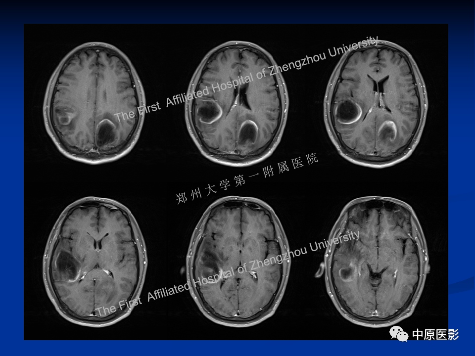 影像PPT - 【病例】脱髓鞘假瘤1例MR影像-9