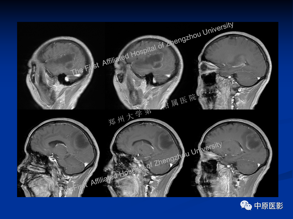 影像PPT - 【病例】脱髓鞘假瘤1例MR影像-10