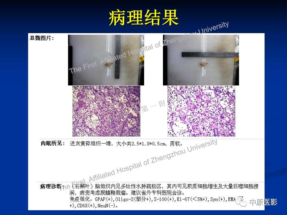 影像PPT - 【病例】脱髓鞘假瘤1例MR影像-14