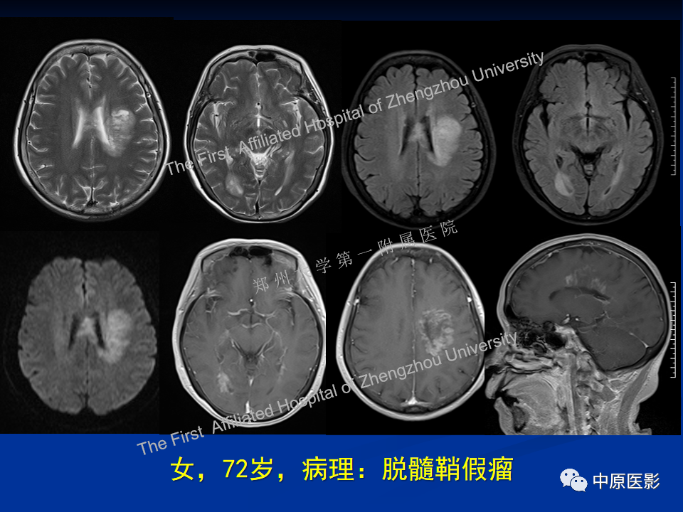 影像PPT - 【病例】脱髓鞘假瘤1例MR影像-18