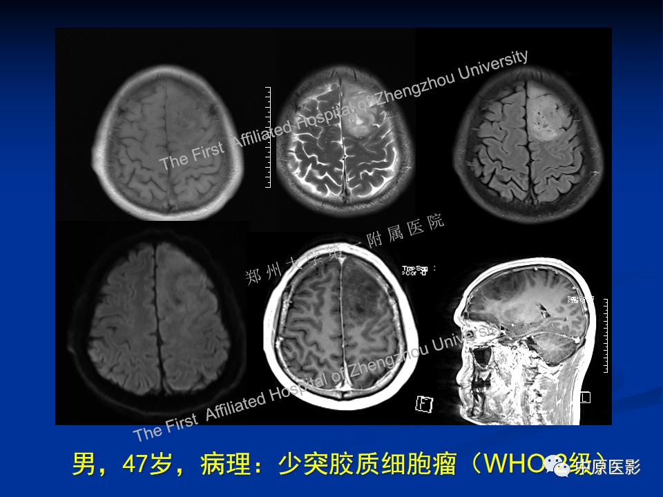 影像PPT - 【病例】脱髓鞘假瘤1例MR影像-22