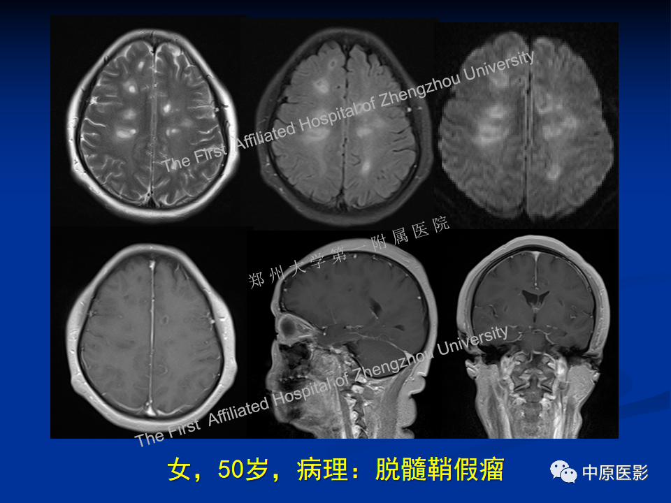 影像PPT - 【病例】脱髓鞘假瘤1例MR影像-19