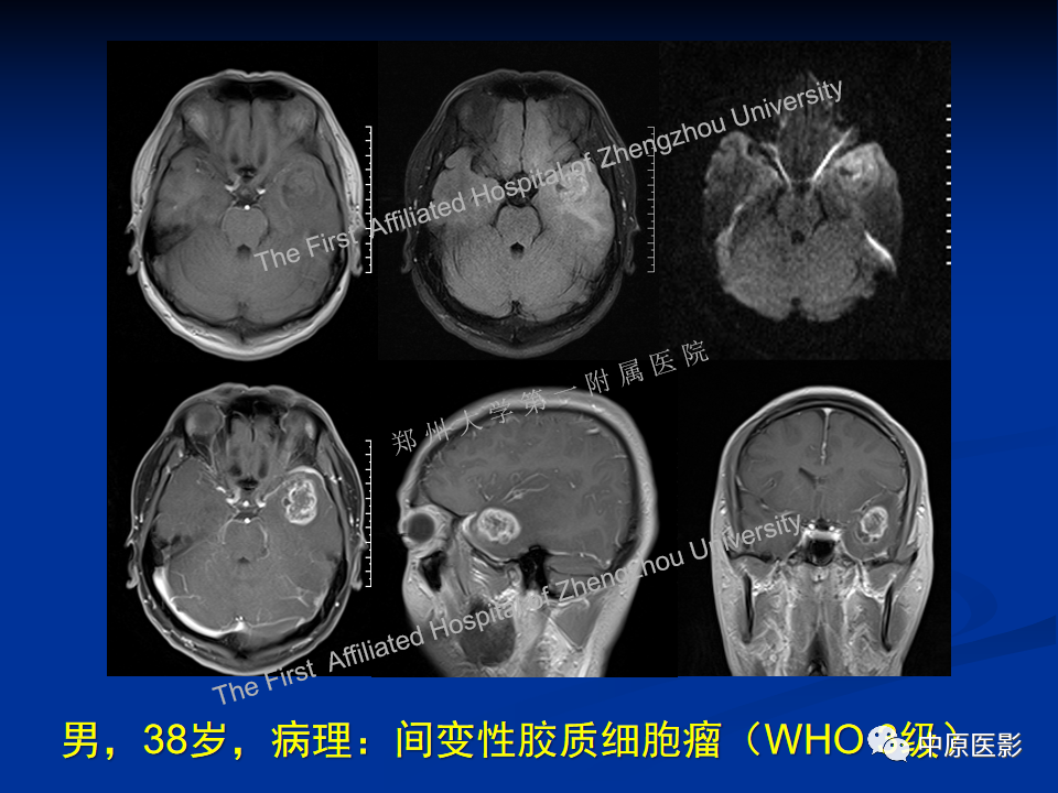 影像PPT - 【病例】脱髓鞘假瘤1例MR影像-23
