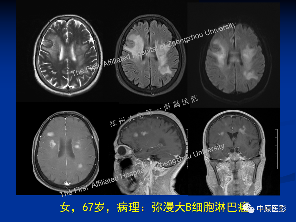 影像PPT - 【病例】脱髓鞘假瘤1例MR影像-25