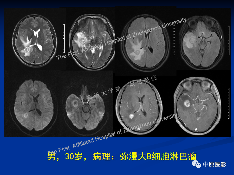 影像PPT - 【病例】脱髓鞘假瘤1例MR影像-26