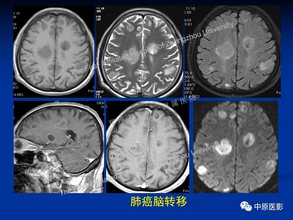 影像PPT - 【病例】脱髓鞘假瘤1例MR影像-28